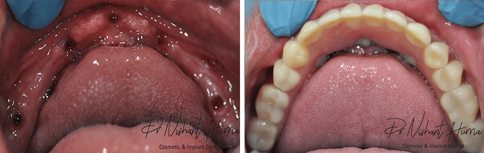 all-on-5-fixed-implant-prosthesis-before-and-after-cosmetic-dentist-warrnambool