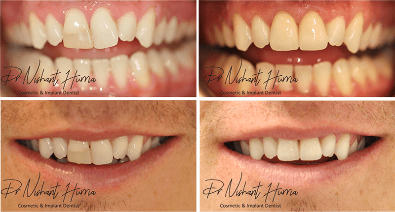 anterior-crowns-before-and-after-cosmetic-dentist-warrnambool