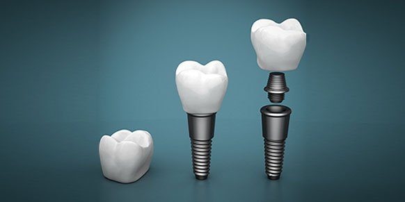 dental implants blurb cosmetic dentist warrnambool