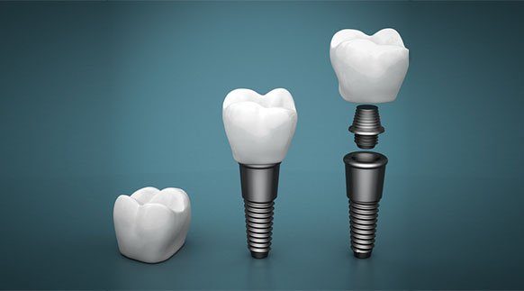 dental implants warrnambool