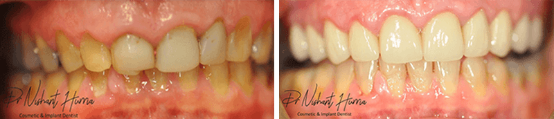 upper-full-arch-crowns-and-veneers-before-and-after-cosmetic-dentist-warrnambool
